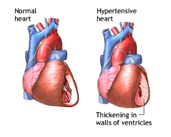 Increased Blood Pressure